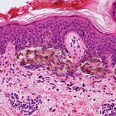 Dermatopathology And Associated Laboratory Investigations In The Study ...